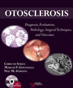 Otosclerosis Diagnosis Evaluation Pathology Surgical Techniques And Outcomes